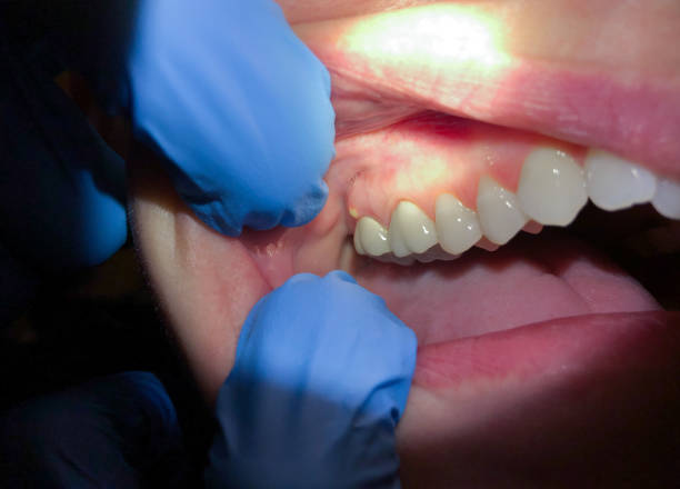 Best Emergency Dental Care for Broken or Chipped Teeth in Montoursville, PA